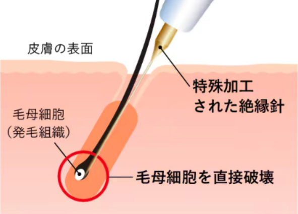 針脱毛の仕組み